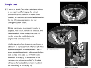 Sample case

A 33 years old female Caucasian patient was referred
    to our department for imaging of a painful,
    subcutaneous nodular lesion in the left lower
    quadrant of the anterior abdominal wall situated at
    the site of the cesarean section she had
    undergone 2 years before.


    Clinical examination at admission revealed a
    palpable, hard nodule, sensitive to pressure. The
    patient reported having noticed this some 18
    months before, the nodule becoming
    progressively painful over time.


    Initial imaging involved ultrasound examination at
    admission as well as contrast-enhanced CT of the
    abdomen and pelvis in our department. The CT
    scans revealed two adjacent solid nodular lesions,
    each some 2 cm in size, one in the left rectus
    abdominis muscle (Fig. 5) and another in the
    corresponding subcutaneous fat (Fig. 6), along
    with signs of a localized inflammatory reaction in
    the surrounding fat tissue (Fig. 7).
 