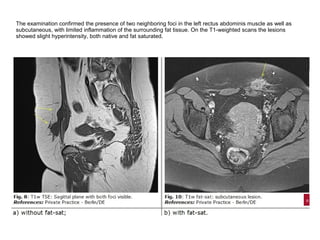 The examination confirmed the presence of two neighboring foci in the left rectus abdominis muscle as well as
subcutaneous, with limited inflammation of the surrounding fat tissue. On the T1-weighted scans the lesions
showed slight hyperintensity, both native and fat saturated.
 
