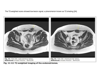 The T2-weighted scans showed low lesion signal, a phenomenon known as T2 shading [24]:
 