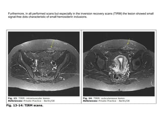 Furthermore, in all performed scans but especially in the inversion recovery scans (TIRM) the lesion showed small
signal-free dots characteristic of small hemosiderin inclusions.
 