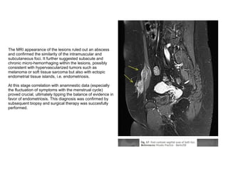 The MRI appearance of the lesions ruled out an abscess
and confirmed the similarity of the intramuscular and
subcutaneous ...