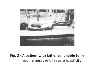 Fig. 2 - A patient with lathyrism unable to lie
supine because of severe spasticity
 
