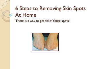 6 Steps to Removing Skin Spots
At Home
There is a way to get rid of those spots!
 