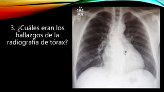3. ¿Cuáles eran los
hallazgos de la
radiografía de tórax?
 