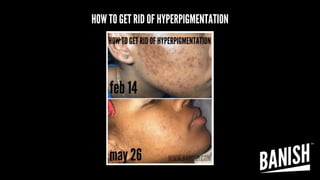 HOW TO GET RID OF HYPERPIGMENTATION
 