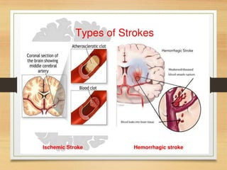 Code Stroke Collor Code Stroke Management / Management of Acute Stroke | PPTX