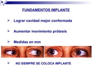 FUNDAMENTOS IMPLANTE
 Lograr cavidad mejor conformada
 Aumentar movimiento prótesis
 Medidas en mm



NO SIEMPRE SE COLOCA IMPLANTE

 