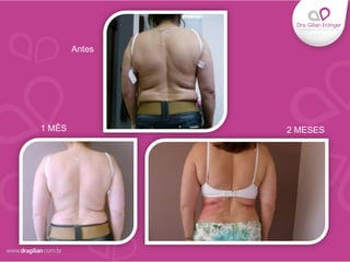 Antes
1 MÊS 2 MESES
 