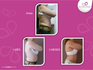 Antes
1 MÊS 2 MESES
 