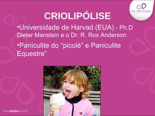 •Universidade de Harvad (EUA) - Ph.D
Dieter Manstein e o Dr. R. Rox Anderson
•Paniculite do “picolé” e Paniculite
Equestre”
CRIOLIPÓLISE
 