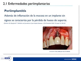 2.1 Enfermedades periimplantarias
Mombelli A (1999) Prevention and therapy of peri-implant infections. In: Lang N & Karrin...