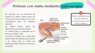 Hernia Ventral Post-Incisional | PDF