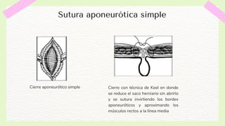 Hernia Ventral Post-Incisional | PDF