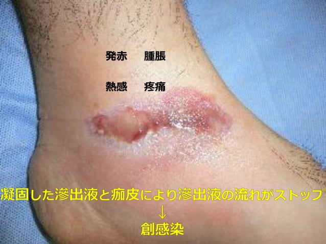 熱傷についての基礎知識 | PDF | First Aid | Injuries