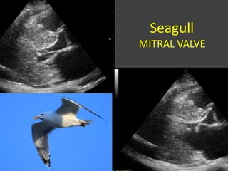 Seagull
MITRAL VALVE
 