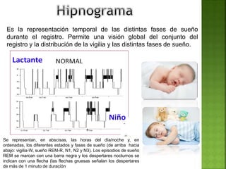 Es la representación temporal de las distintas fases de sueño
durante el registro. Permite una visión global del conjunto del
registro y la distribución de la vigilia y las distintas fases de sueño.
Se representan, en abscisas, las horas del día/noche y, en
ordenadas, los diferentes estados y fases de sueño (de arriba hacia
abajo: vigilia-W, sueño REM-R, N1, N2 y N3). Los episodios de sueño
REM se marcan con una barra negra y los despertares nocturnos se
indican con una flecha (las flechas gruesas señalan los despertares
de más de 1 minuto de duración
 