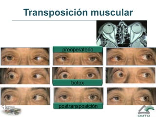 Transposición muscular<br />preoperatorio<br />botox<br />postransposición<br />