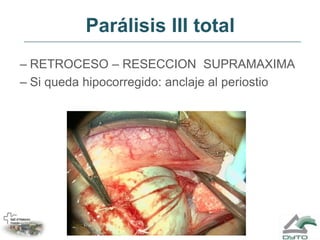 Parálisis III total<br />RETROCESO – RESECCION  SUPRAMAXIMA<br />Si queda hipocorregido: anclaje al periostio<br />