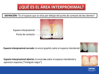 Espacio interproximal
Punto de contacto
¿QUÉ ES EL ÁREA INTERPROXIMAL?
DEFINICIÓN: “Es el espacio que se sitúa por debajo del punto de contacto de dos dientes”
Espacio interproximal cerrado: la encía (papila) cubre el espacio interdental
Espacio interproximal abierto: la encía no cubre el espacio interdental y
aparecen espacios (“triángulo negro”)
 