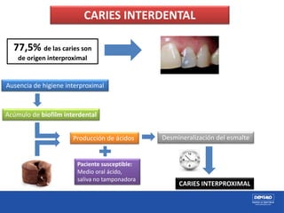 CARIES INTERDENTAL
Ausencia de higiene interproximal
Acúmulo de biofilm interdental
Producción de ácidos Desmineralización del esmalte
CARIES INTERPROXIMAL
77,5% de las caries son
de origen interproximal
Paciente susceptible:
Medio oral ácido,
saliva no tamponadora
 