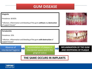 GUM DISEASE
Gingivitis
Prevalence: 60-85%
“Infection, inflammation and bleeding of the gums without any destruction
of support tissues”
Periodontitis
Prevalence: 35%
“Infection, inflammation and bleeding of the gums with destruction of
support tissues”
Absence of
interdental hygiene
Accumulation of plaque in
interdental space and in the
gingival sulcus
INFLAMMATION OF THE GUM
AND DEEPENING OF PLAQUE
THE SAME OCCURS IN IMPLANTS
 