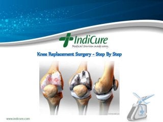 Knee Replacement Surgery - Step By Step
 