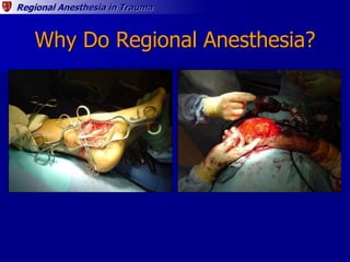 Regional Anesthesia in Trauma
Why Do Regional Anesthesia?
 