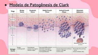 ● Modelo de Patogénesis de Clark
 
