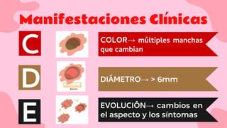 Manifestaciones Clínicas
C
D
E
DIÁMETRO→ > 6mm
COLOR→ múltiples manchas
que cambian
EVOLUCIÓN→ cambios en
el aspecto y los síntomas
 