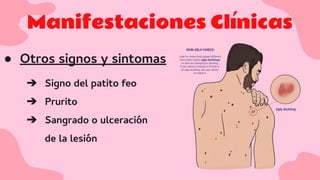 Manifestaciones Clínicas
● Otros signos y sintomas
➔ Signo del patito feo
➔ Prurito
➔ Sangrado o ulceración
de la lesión
 