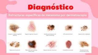 Diagnóstico
Estructuras especíﬁcas de melanoma por dermatoscopia
 