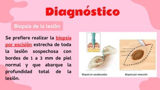 Diagnóstico
Biopsia de la lesión
Se preﬁere realizar la biopsia
por escisión estrecha de toda
la lesión sospechosa con
bordes de 1 a 3 mm de piel
normal y que abarque la
profundidad total de la
lesión.
 
