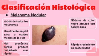 Clasiﬁcación Histológica
● Melanoma Nodular
15-30% de todos los
melanomas
Usualmente en piel
sana, a edades
medias de la vida
Nódulos de color
negro azulado con
bordes lisos
Rápido crecimiento
en profundidad
Mal pronóstico
porque produce
metástasis más
rápido
 