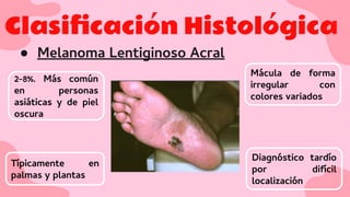 Clasiﬁcación Histológica
● Melanoma Lentiginoso Acral
2-8%. Más común
en personas
asiáticas y de piel
oscura
Mácula de forma
irregular con
colores variados
Diagnóstico tardío
por difícil
localización
Típicamente en
palmas y plantas
 