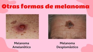 Otras formas de melanoma
Melanoma
Amelanótico
Melanoma
Desplomástico
 