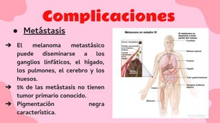 Complicaciones
● Metástasis
➔ El melanoma metastásico
puede diseminarse a los
ganglios linfáticos, el hígado,
los pulmones, el cerebro y los
huesos.
➔ 5% de las metástasis no tienen
tumor primario conocido.
➔ Pigmentación negra
característica.
 