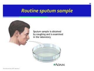 Sputum Routine PneumoniaCheck by ARC Medical, The link between diagnosis and treatment ...