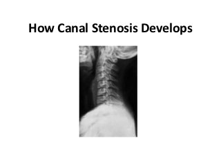 How Canal Stenosis Develops
 