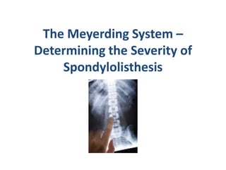 The Meyerding System –
Determining the Severity of
    Spondylolisthesis
 