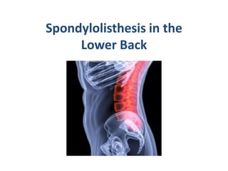 Spondylolisthesis in the
     Lower Back
 