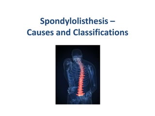 Spondylolisthesis –
Causes and Classifications
 