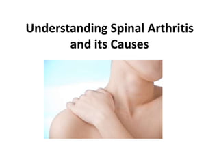 Understanding Spinal Arthritis
       and its Causes
 