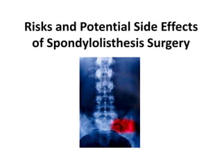 Risks and Potential Side Effects
 of Spondylolisthesis Surgery
 