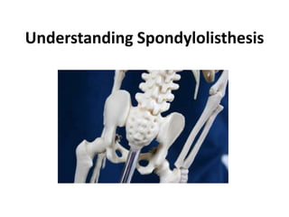 Understanding Spondylolisthesis
 