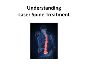 Understanding
Laser Spine Treatment
 