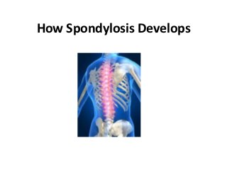 How Spondylosis Develops
 