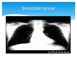 Viewing chest x ray | PPTX