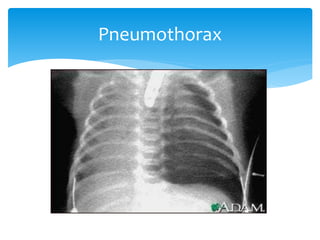 Viewing chest x ray | PPTX