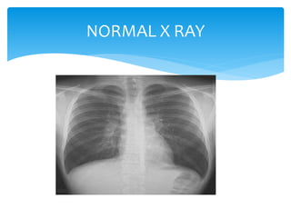 Viewing chest x ray | PPTX