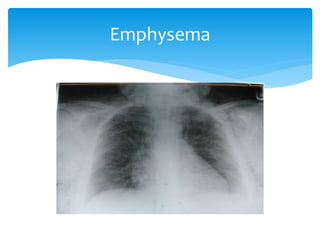 Viewing chest x ray | PPTX